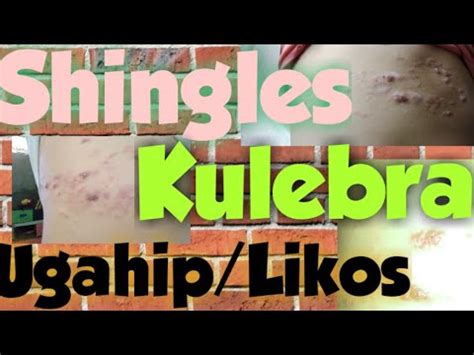 kulebra treatment|shingles causes symptoms and treatment.